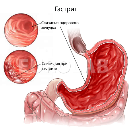 Хронический гастрит и гастродуоденит у детей