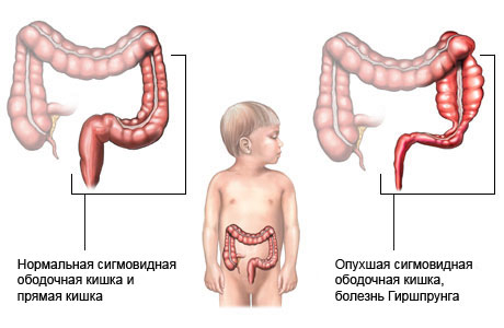 Болезнь Гиршпрунга у детей