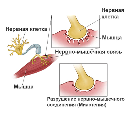 миастения