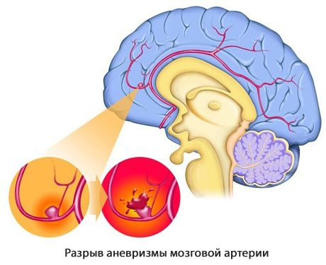 Аневризма у детей