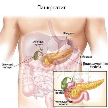 Острый панкреатит у детей