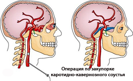 Каротидно-кавернозное соустье у детей