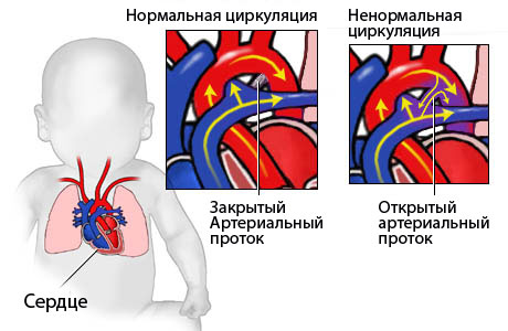 Врожденные пороки сердца (ВПС) у детей