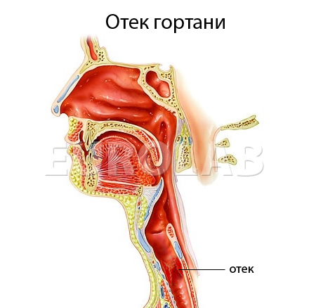 Отек Квинке у детей