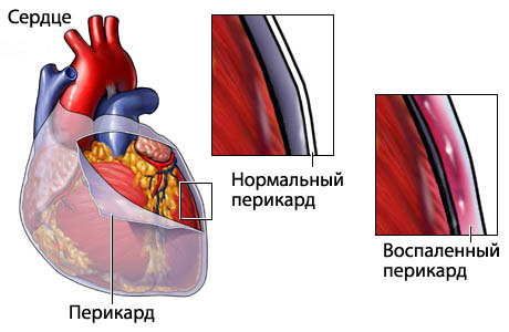 Перикардит у детей