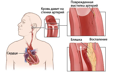 Артериальная гипертензия у детей