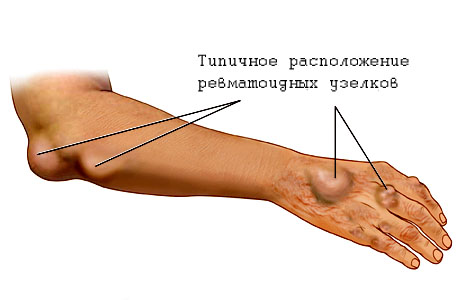 Ревматизм у детей